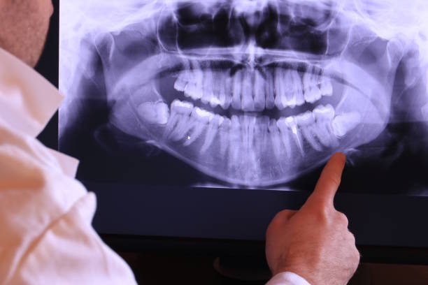 Best Emergency Wisdom Teeth Removal in Glen Lyon, PA